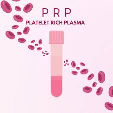 Pure PRP hay LP-PRP nên được sử dụng trong thoái hóa khớp